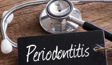 Mehr über Parodontitis