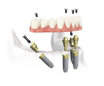 All-on-4® System Unterkiefer © Completdent All-on-4® System Unterkiefer © Completdent