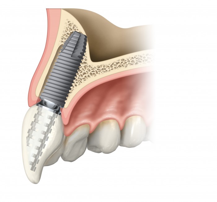 Frontalzahnimplantat
