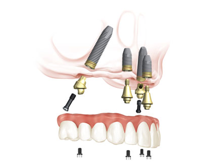All-on-4® System Oberkiefer © Completdent All-on-4® System Oberkiefer © Completdent