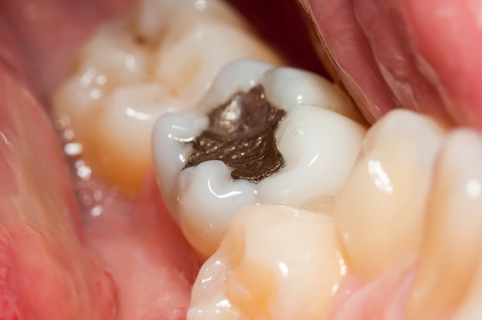 Aus ästhetischen und gesundheitlichen Gründen verzichten die Ärzte von Completdent auf die Verwendung von Amalgam
