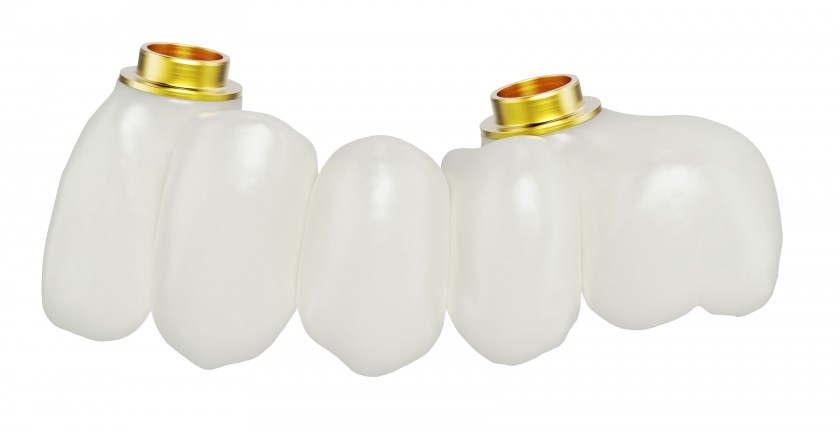 Implantatgetragene Zahnbrücke von Nobel Biocare