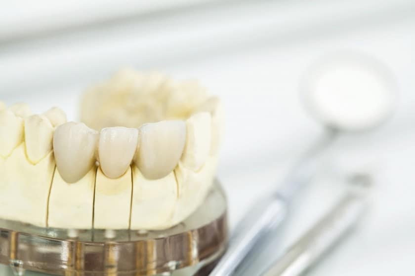 Keramische Zahnkronen