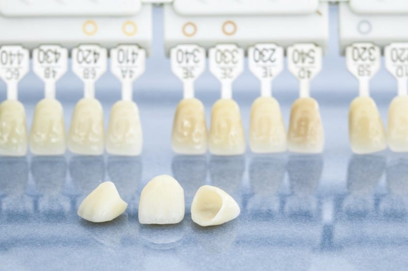 Zahnkronen im Frontzahnbereich sind in der Regel günstiger