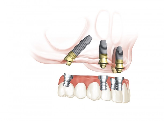 Stegprothese Modell © Completdent Stegprothese Modell © Completdent